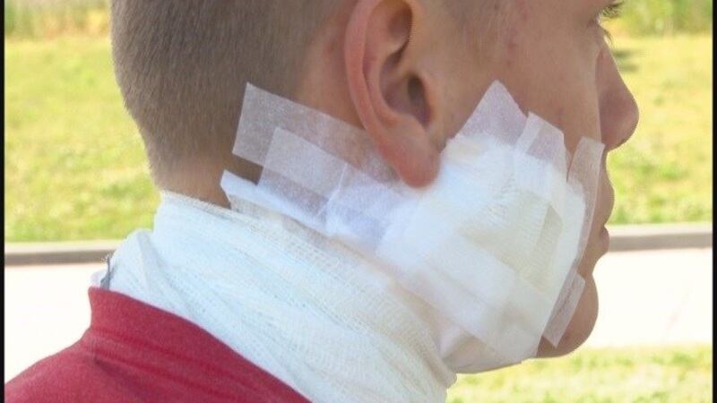 Albertville student recovering from vape machine battery explosion Albertville student recovering from vape machine battery explosion