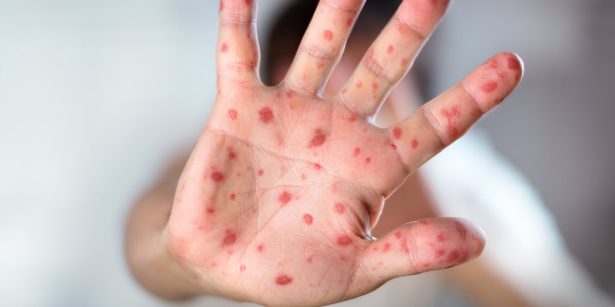 Measles Case Reported in Huntsville After International Traveler Visits Bailey Cove Businesses