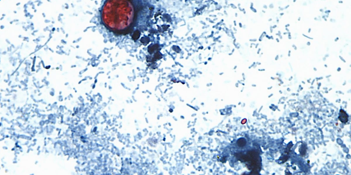 Alabama Cyclospora cases grow; North Alabama hit hardest